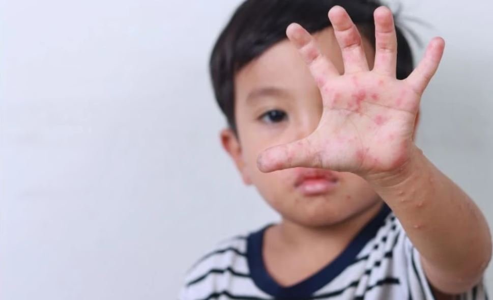 Atasi Campak pada Usia Anak, Jangan Sepelekan Pentingnya Imunisasi